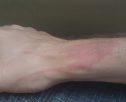 Burnt Arm