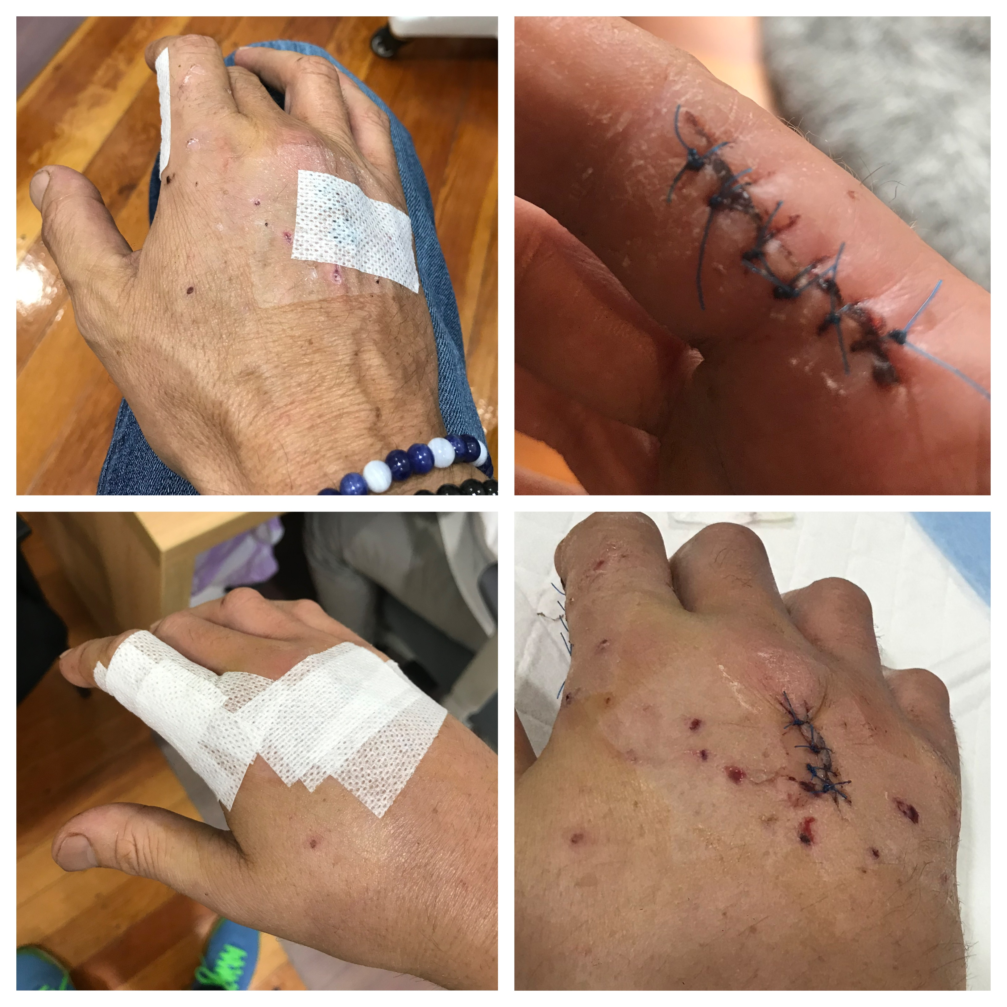 Hand Injury after dog attack
