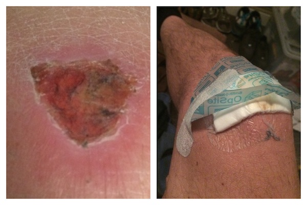 Busted Knee