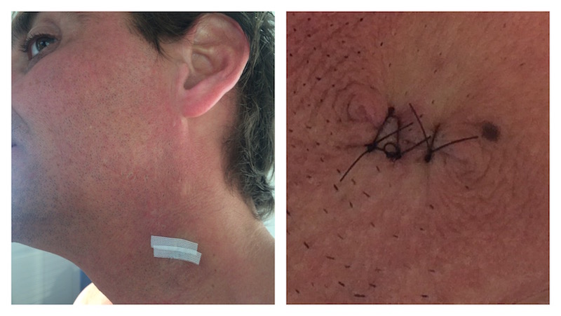 Lump Removed