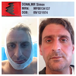 wisdom teeth removal